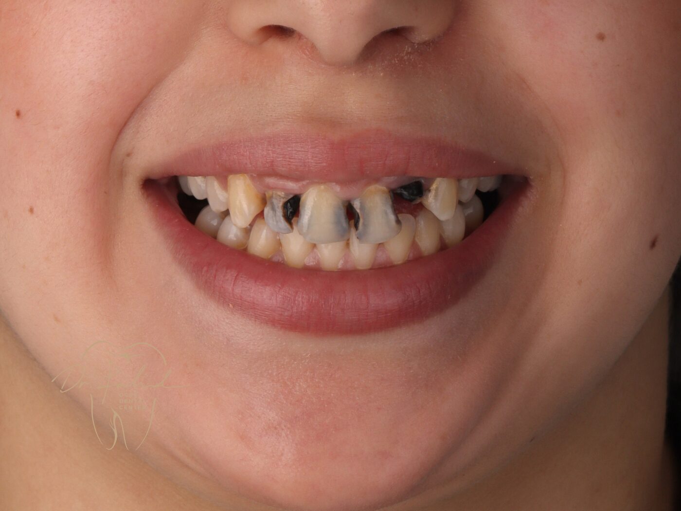 Avant — Cas réel — Couronne zircone, Dr. Fahd, dentiste à Marrakech
