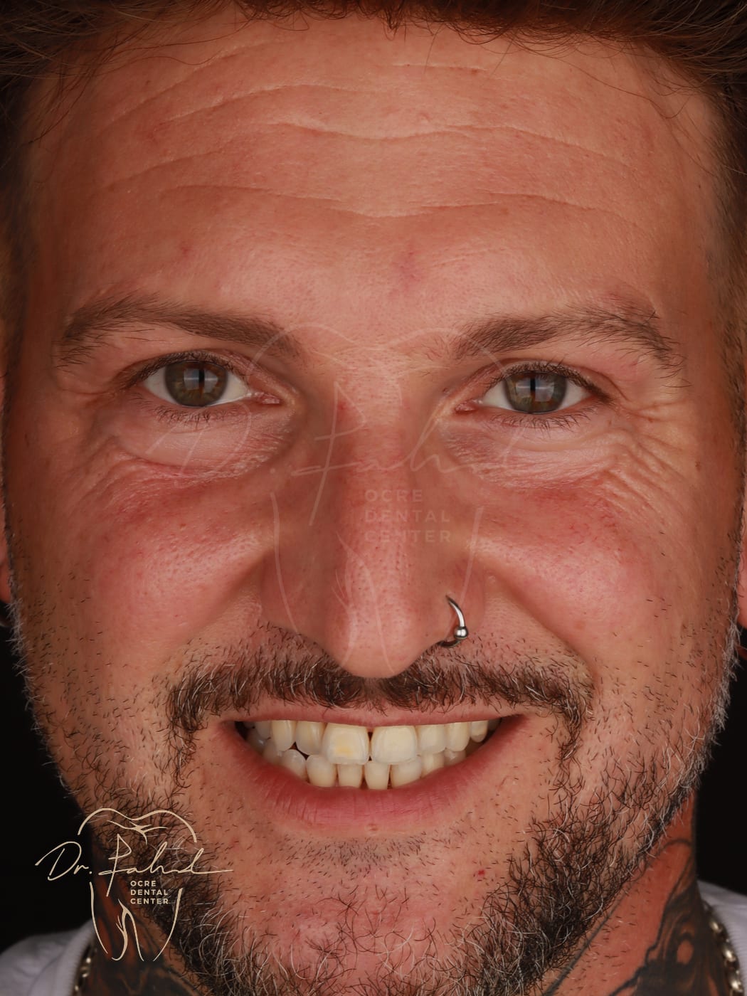 Avant — Cas réel — Facettes composite, Dr. Fahd, dentiste à Marrakech