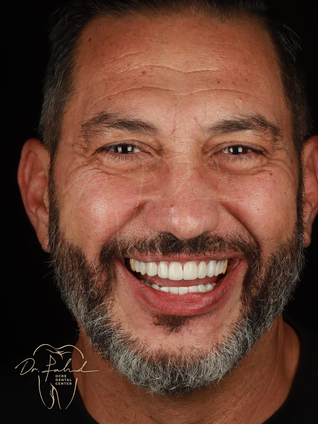 Après — Cas réel — Facettes composite, Dr. Fahd, dentiste à Marrakech