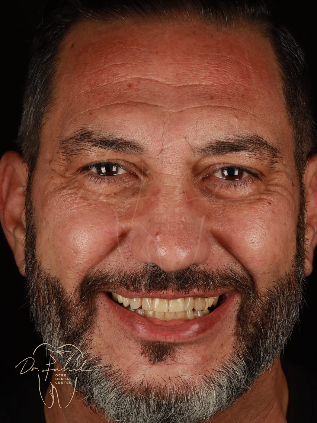Avant — Cas réel — Facettes composite, Dr. Fahd, dentiste à Marrakech