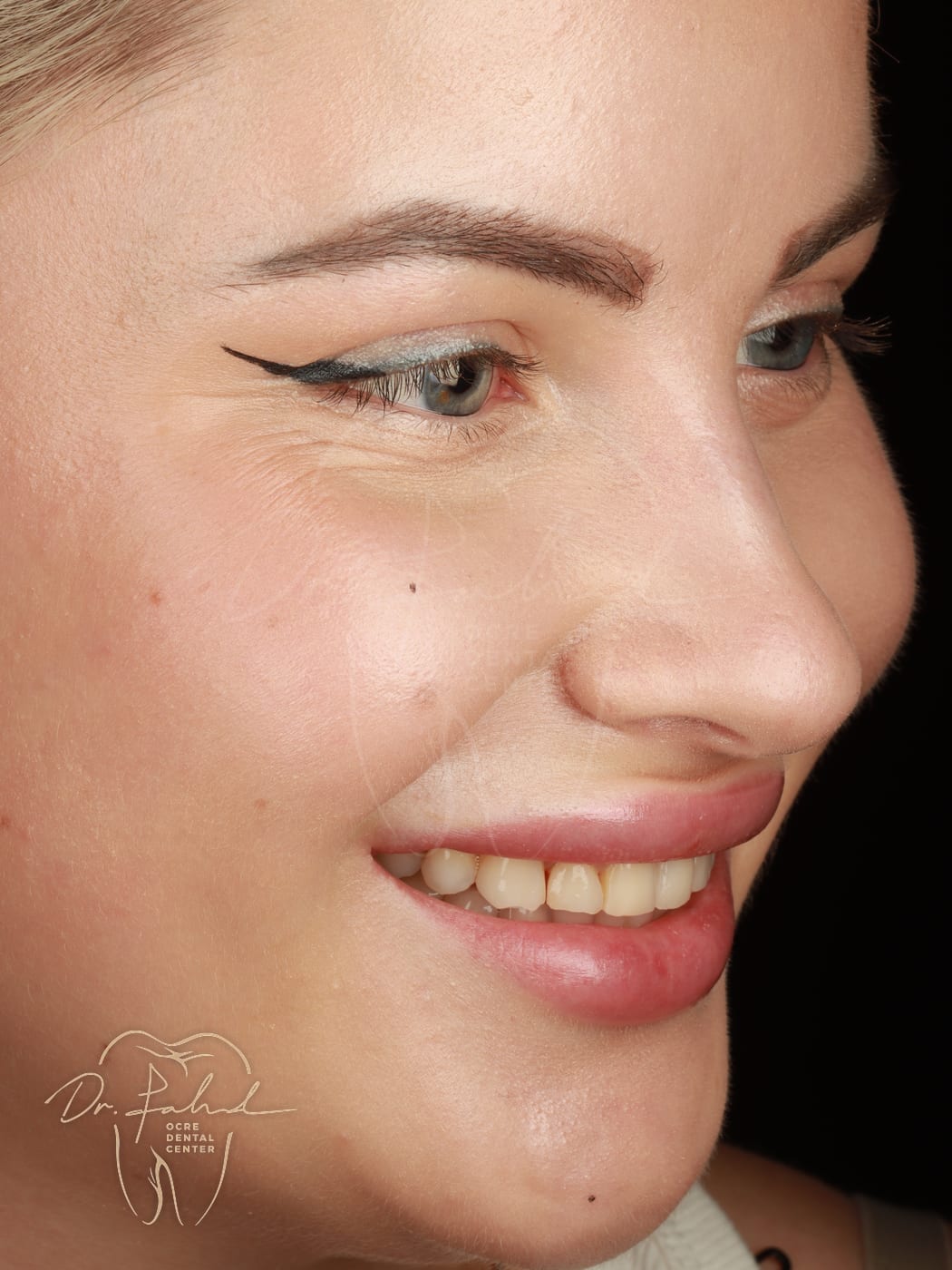 Avant — Cas réel — Facettes composite, Dr. Fahd, dentiste à Marrakech