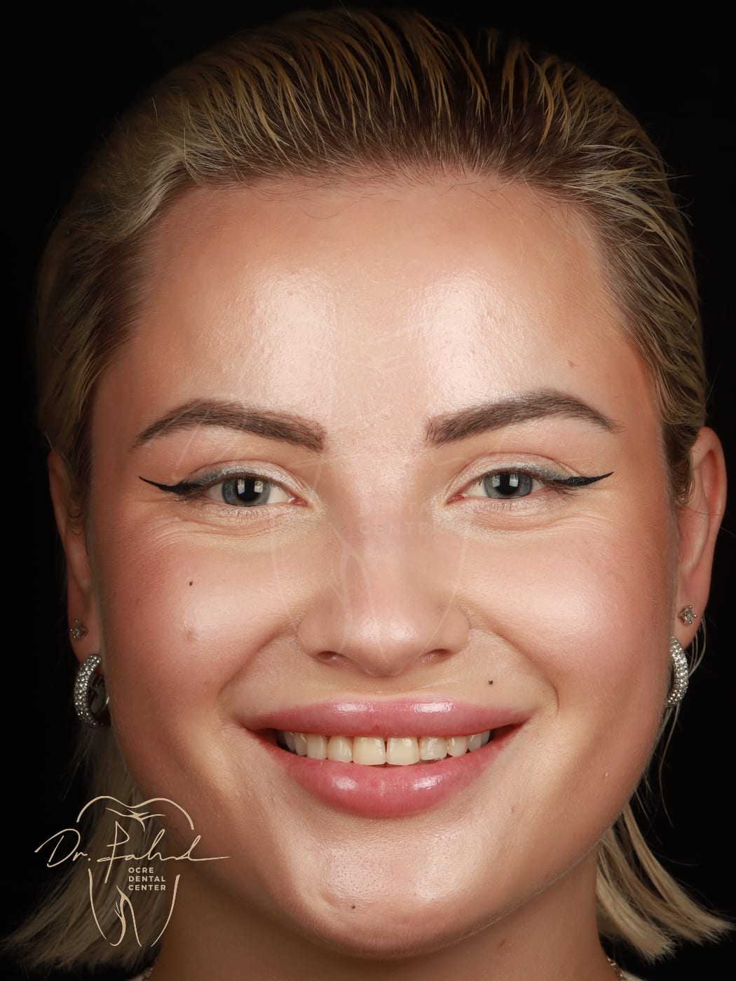 Avant — Cas réel — Facettes composite, Dr. Fahd, dentiste à Marrakech
