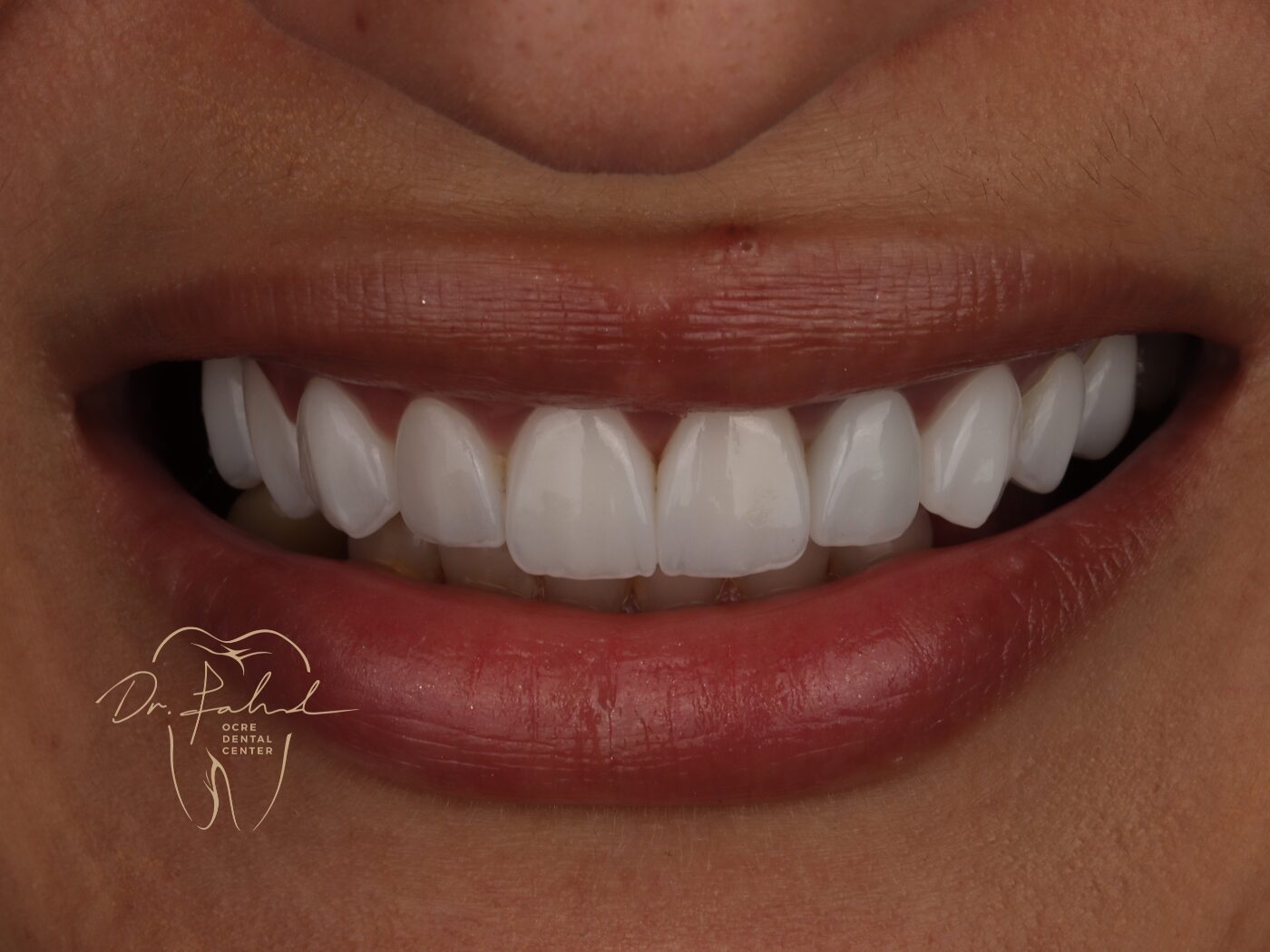 After — Real case — Emax Veneers, Dr. Fahd, dentist in Marrakech