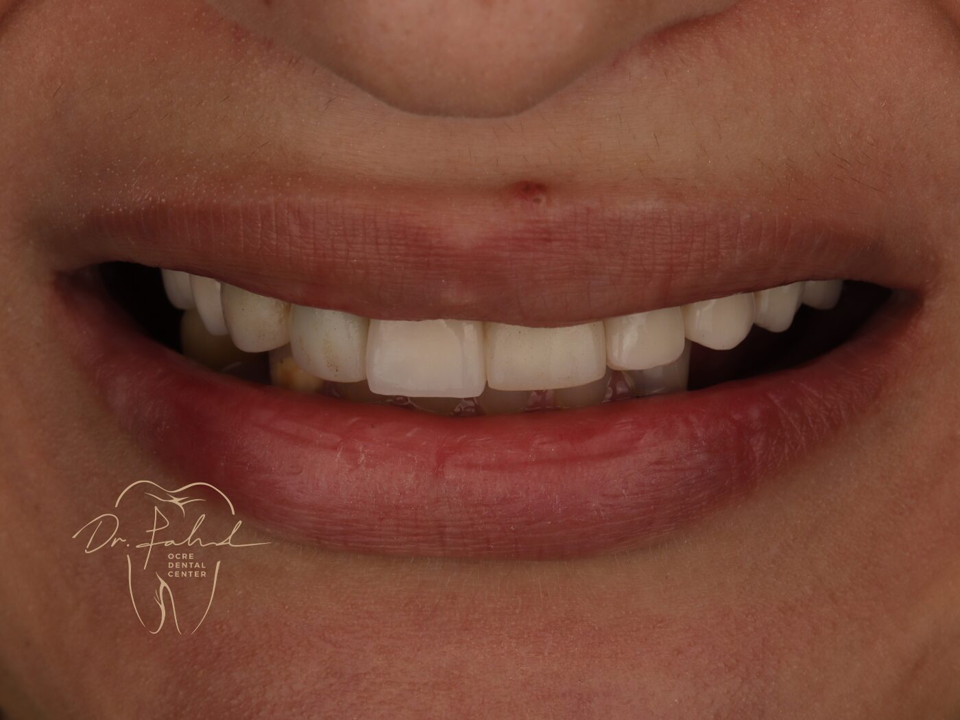 Before — Real case — Emax Veneers, Dr. Fahd, dentist in Marrakech