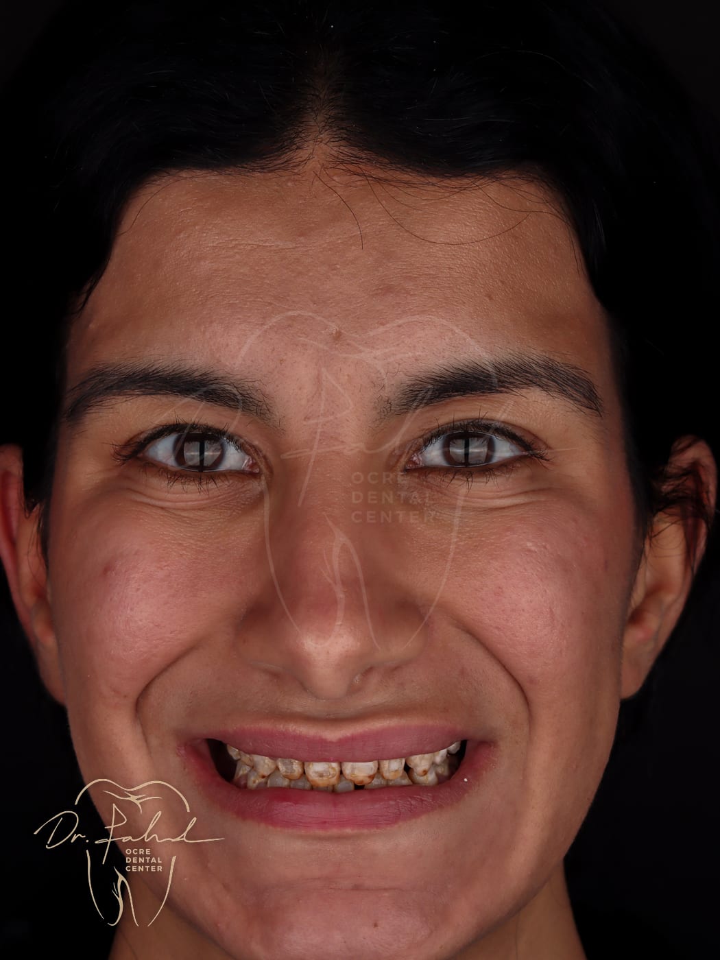 Avant — Cas réel — Facettes Emax, Dr. Fahd, dentiste à Marrakech