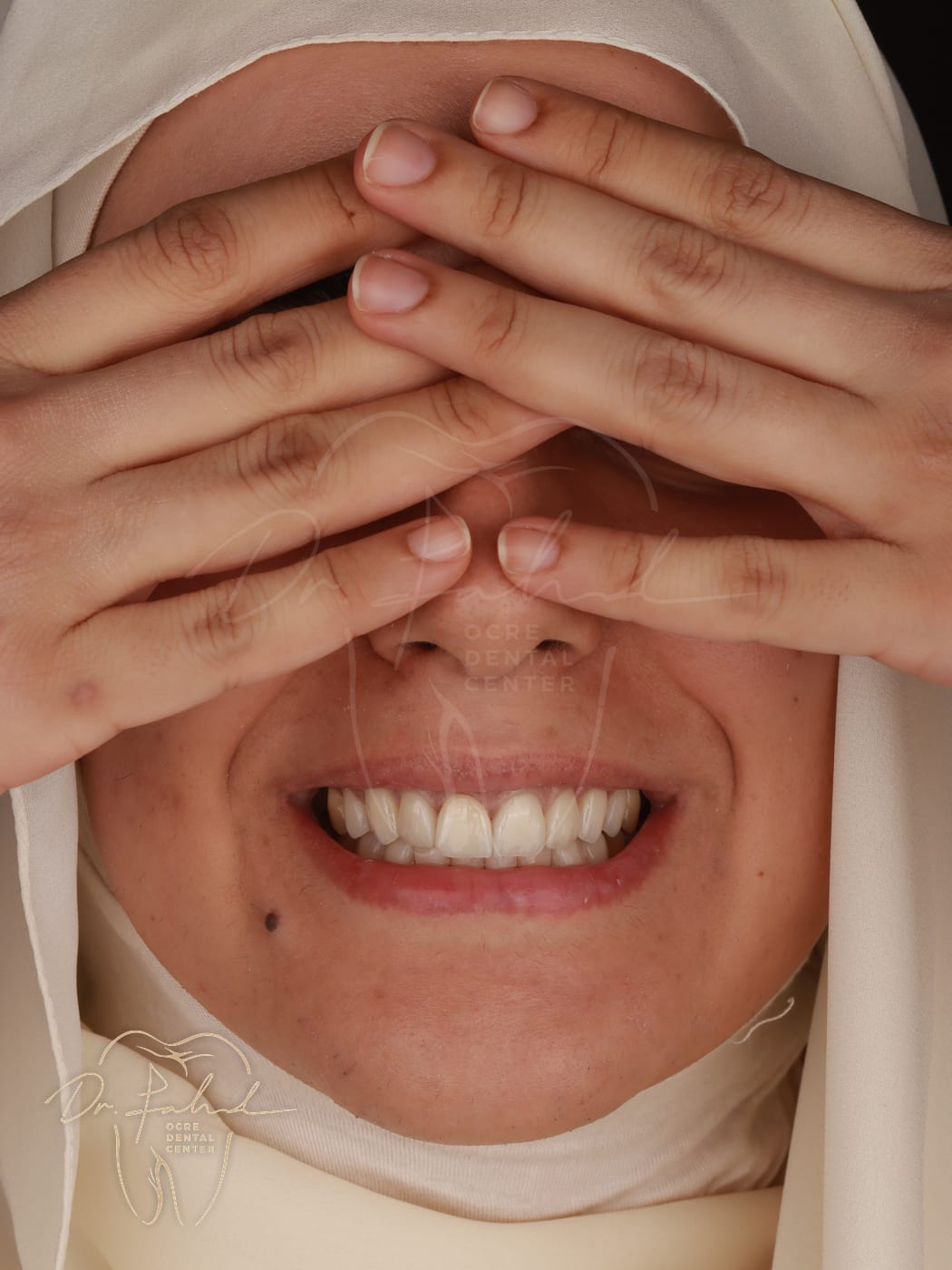 Après — Cas réel — Facettes Emax, Dr. Fahd, dentiste à Marrakech