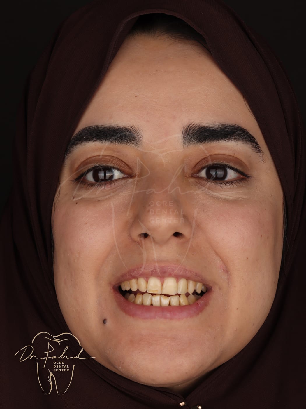 Avant — Cas réel — Facettes Emax, Dr. Fahd, dentiste à Marrakech