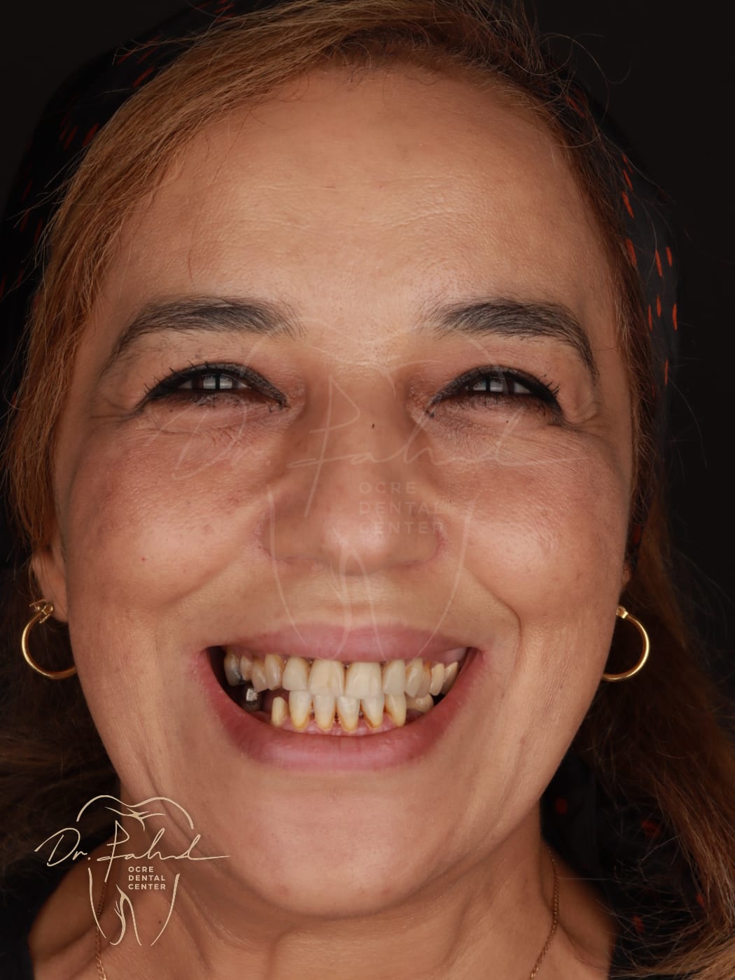 Avant — Cas réel — Facettes Emax, Dr. Fahd, dentiste à Marrakech