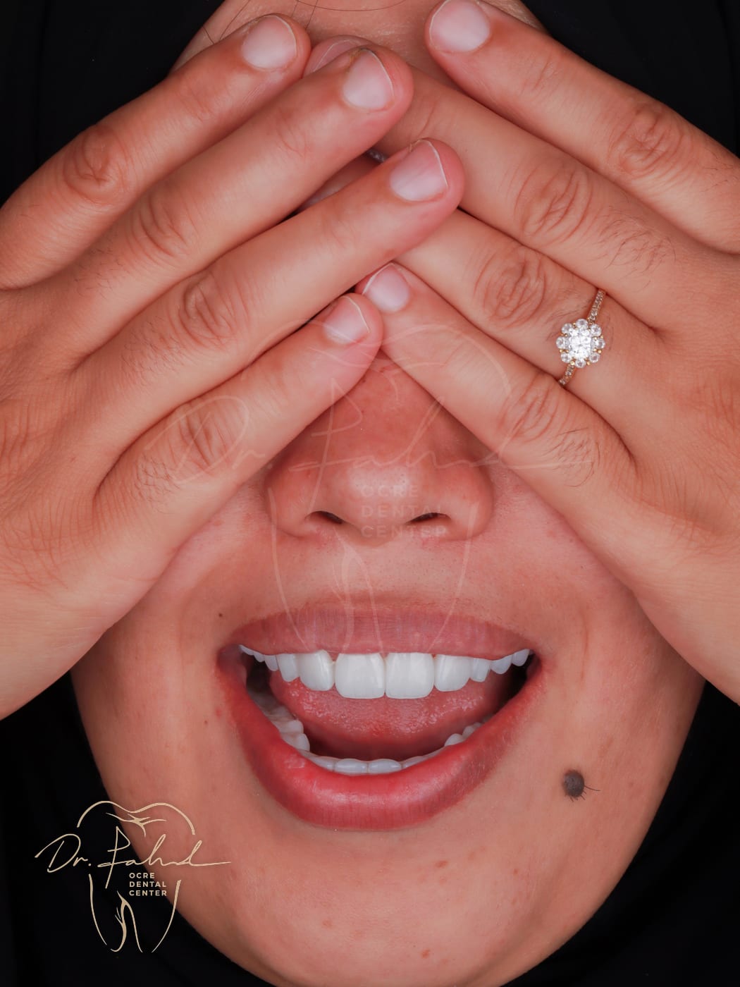 After — Real case — Emax Veneers, Dr. Fahd, dentist in Marrakech