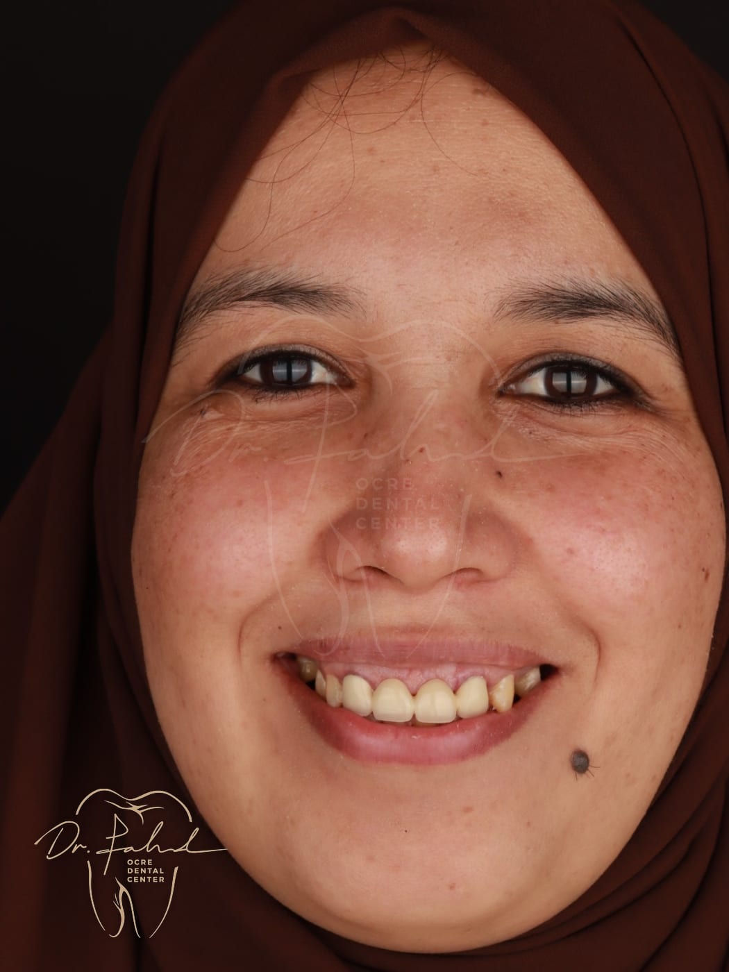 Before — Real case — Emax Veneers, Dr. Fahd, dentist in Marrakech