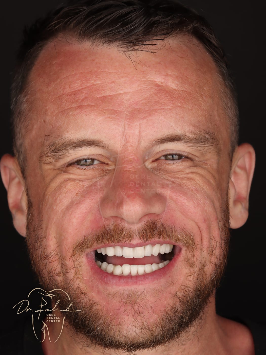 After — Real case — Emax Veneers, Dr. Fahd, dentist in Marrakech