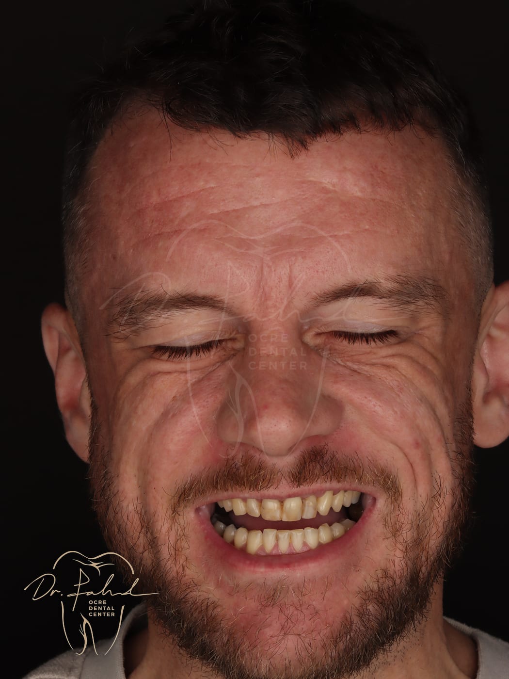 Before — Real case — Emax Veneers, Dr. Fahd, dentist in Marrakech