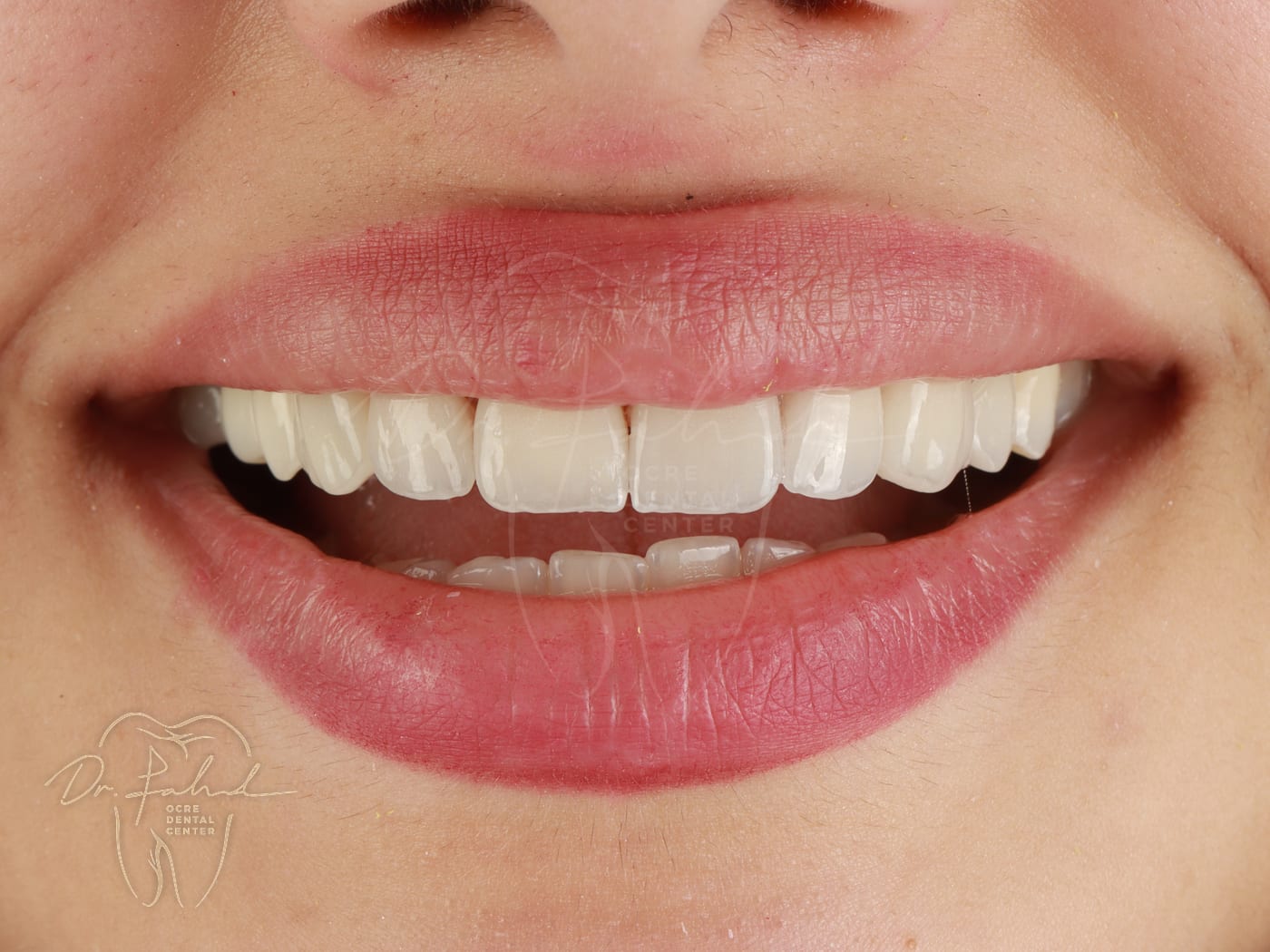 After — Real case — Emax Veneers, Dr. Fahd, dentist in Marrakech