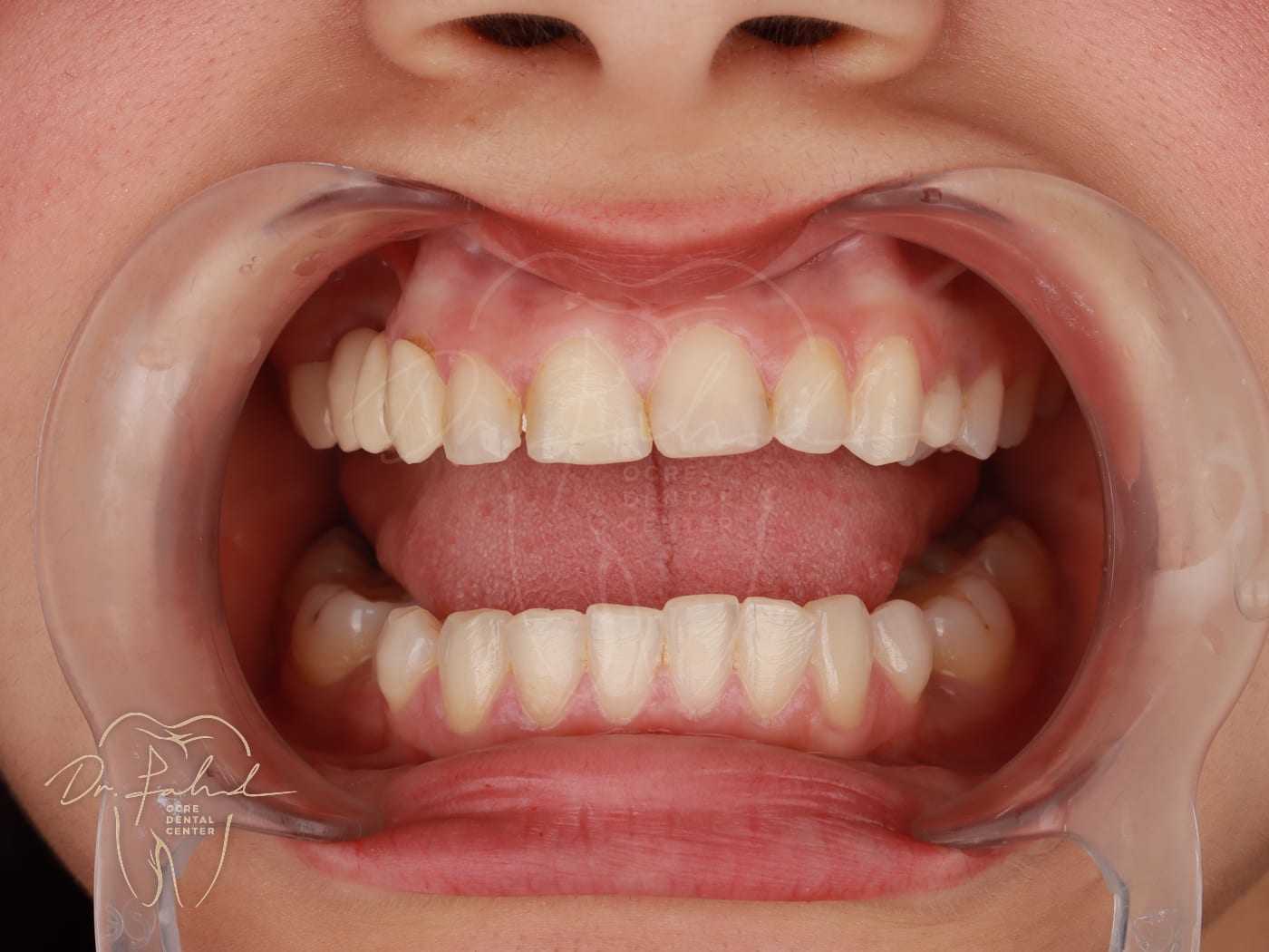 Before — Real case — Emax Veneers, Dr. Fahd, dentist in Marrakech