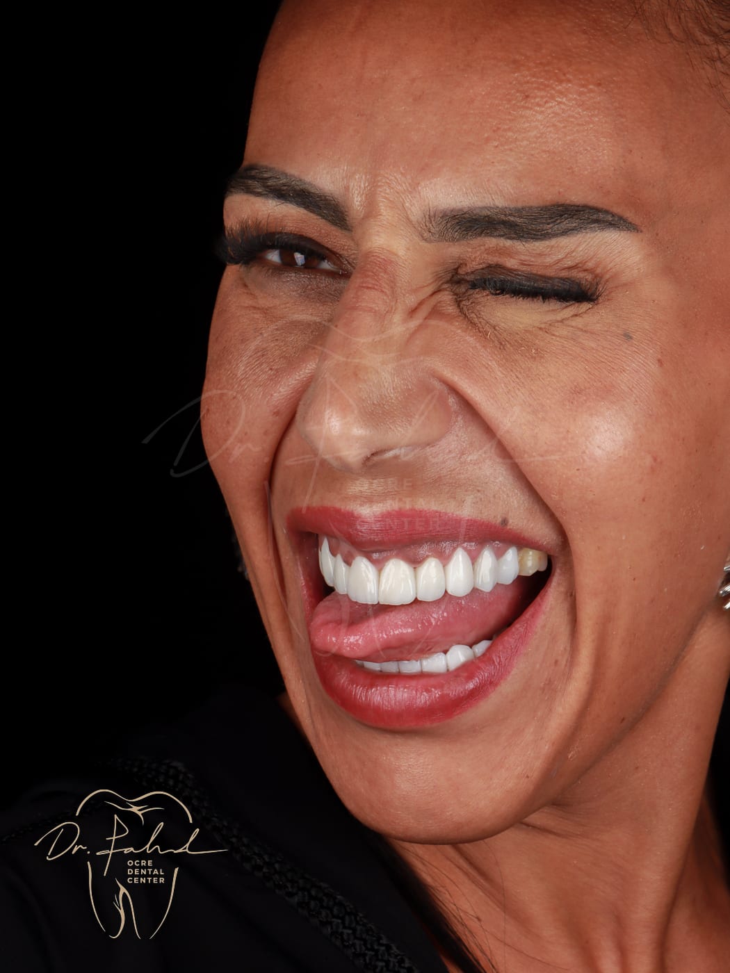 Après — Cas réel — Réhabilitation du sourire, Dr. Fahd, dentiste à Marrakech