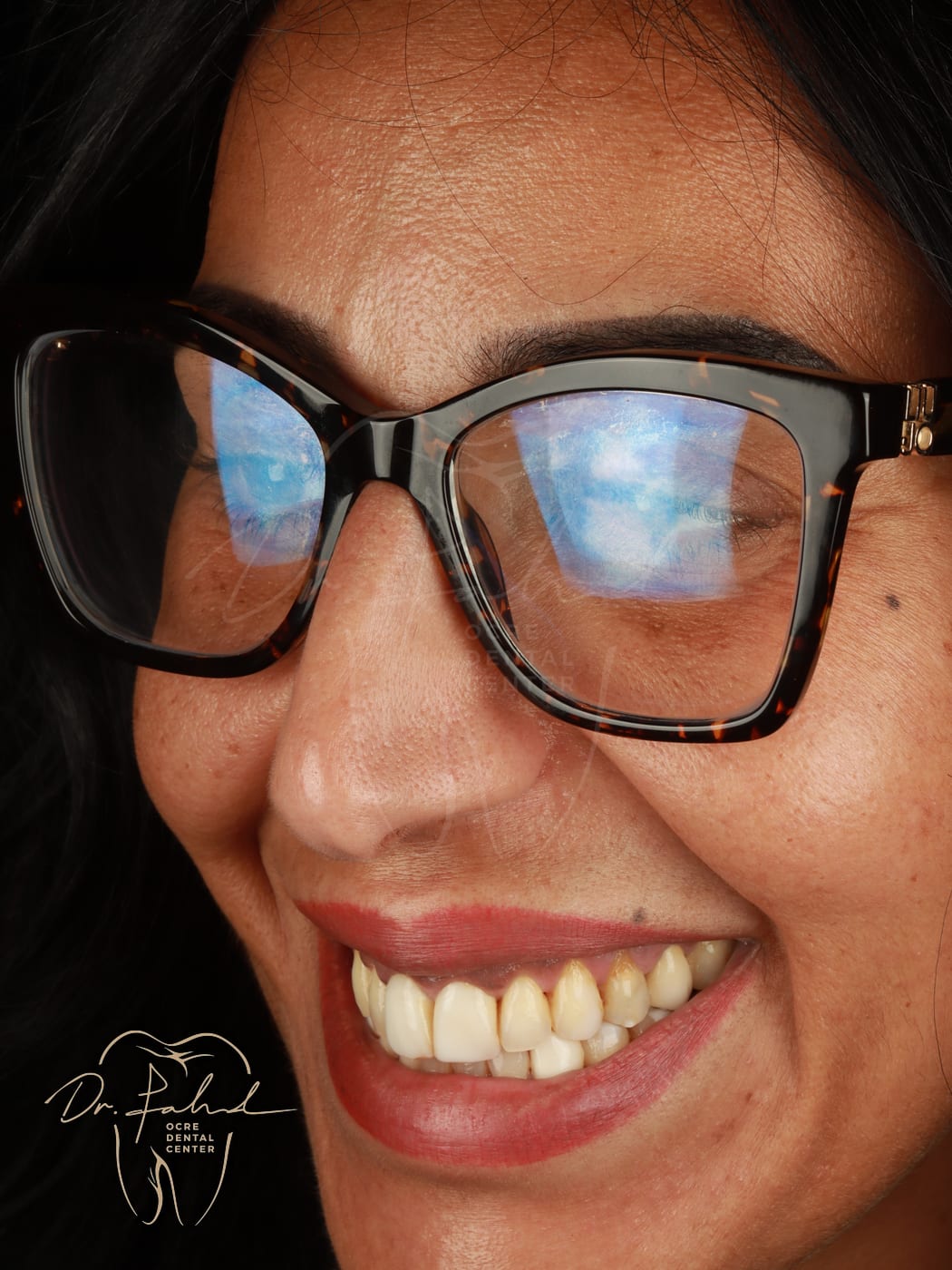 Avant — Cas réel — Réhabilitation du sourire, Dr. Fahd, dentiste à Marrakech