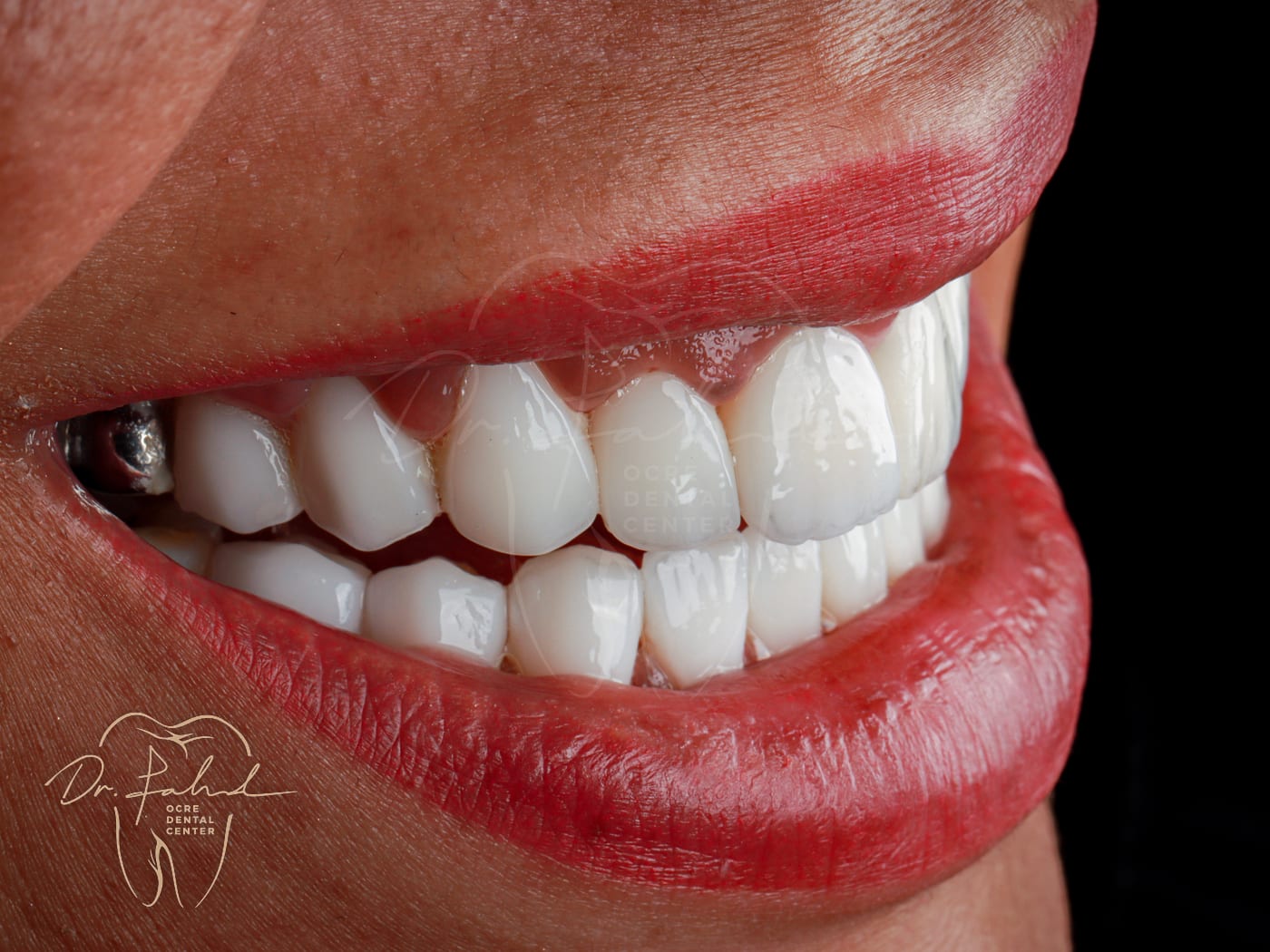 Après — Cas réel — Réhabilitation du sourire, Dr. Fahd, dentiste à Marrakech
