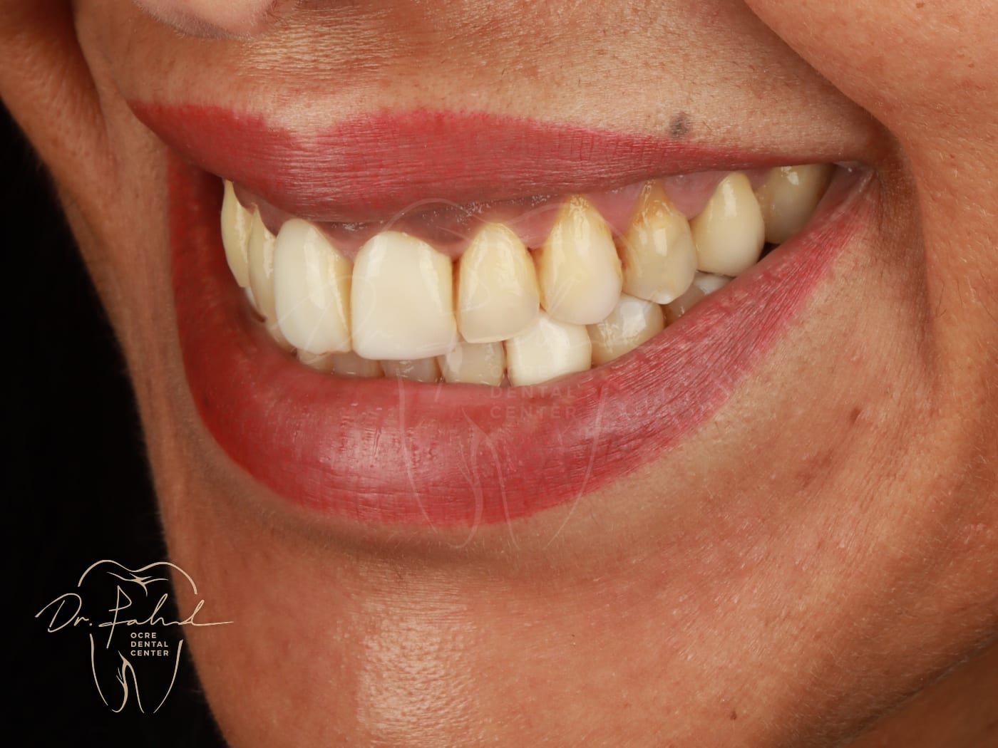 Avant — Cas réel — Réhabilitation du sourire, Dr. Fahd, dentiste à Marrakech