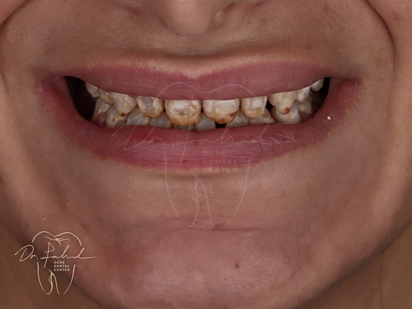 Avant — Cas réel — Réhabilitation du sourire, Dr. Fahd, dentiste à Marrakech