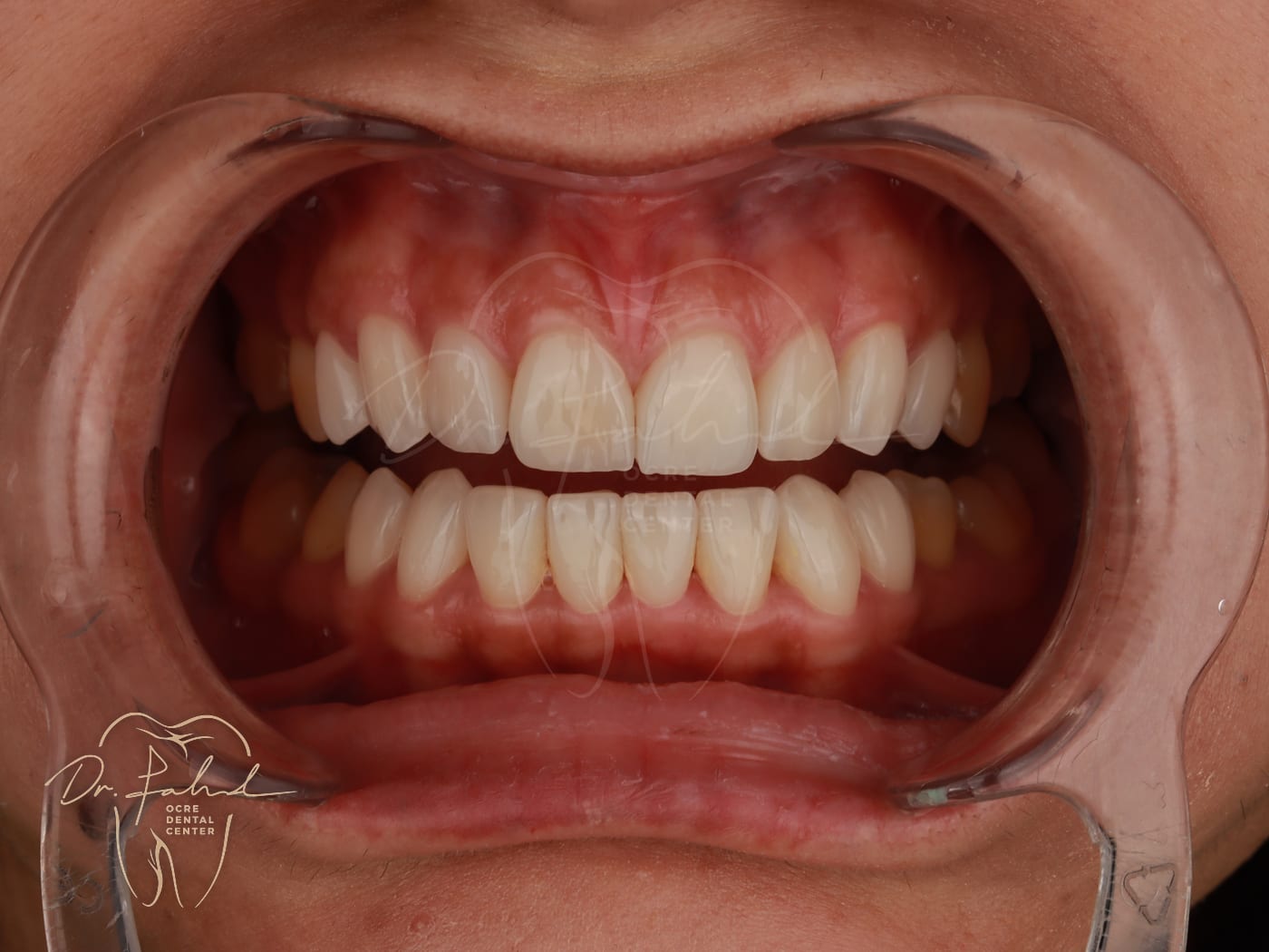 Après — Cas réel — Réhabilitation du sourire, Dr. Fahd, dentiste à Marrakech