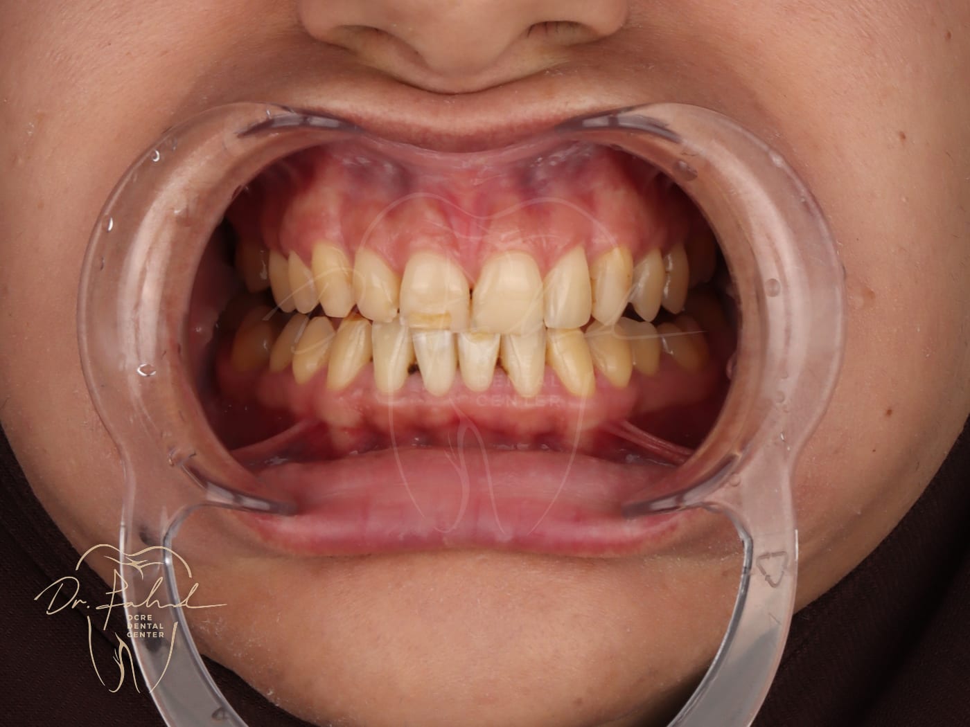 Avant — Cas réel — Réhabilitation du sourire, Dr. Fahd, dentiste à Marrakech