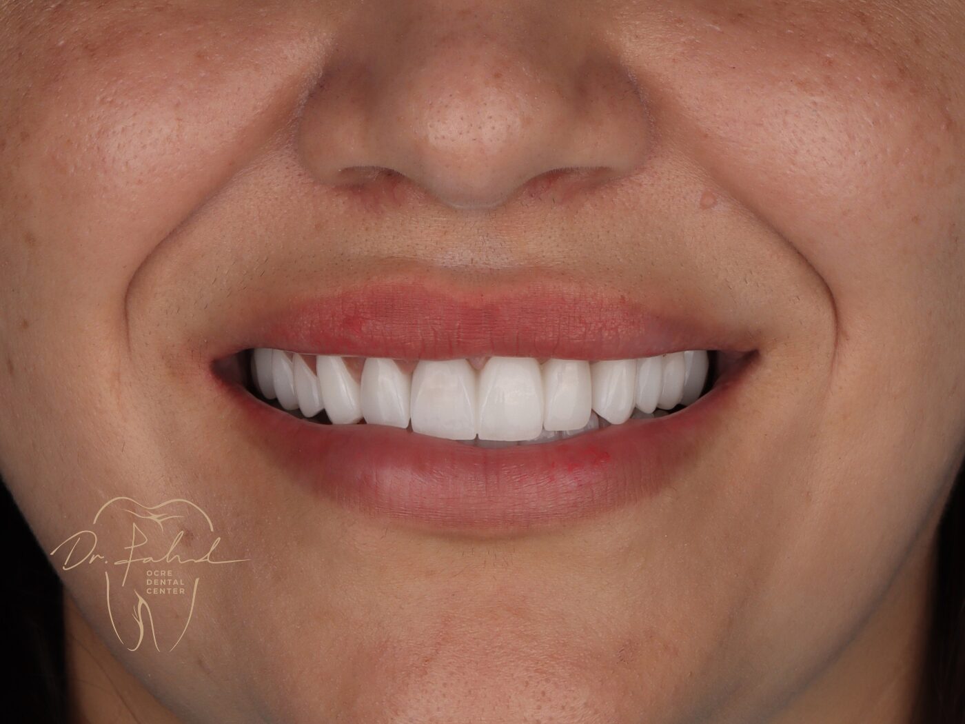 Après — Cas réel — Réhabilitation du sourire, Dr. Fahd, dentiste à Marrakech
