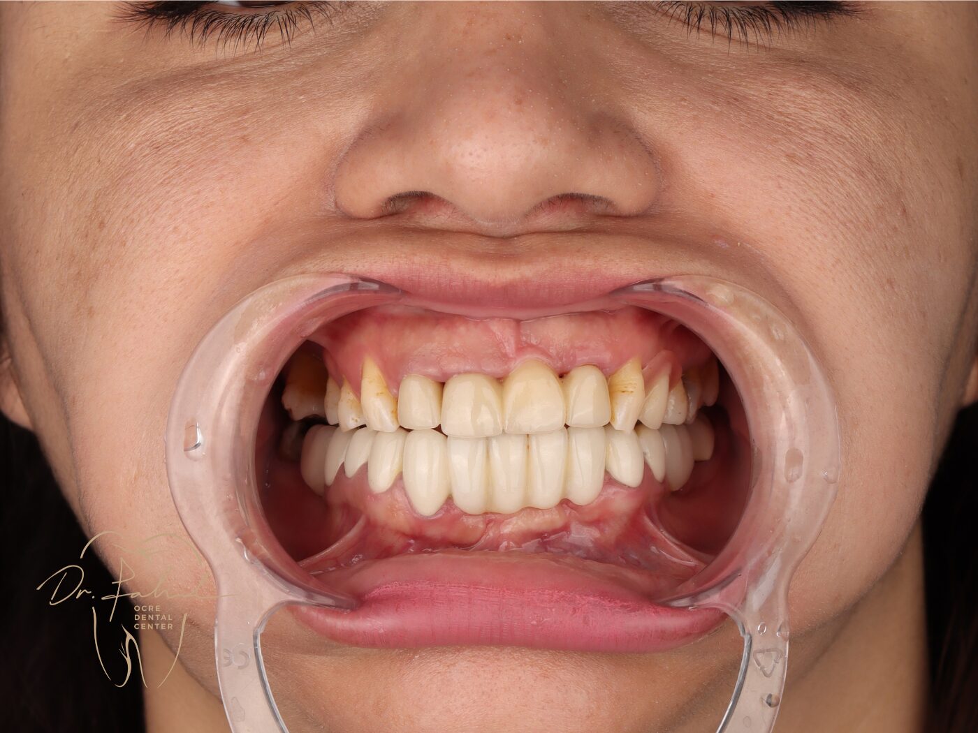 Avant — Cas réel — Réhabilitation du sourire, Dr. Fahd, dentiste à Marrakech