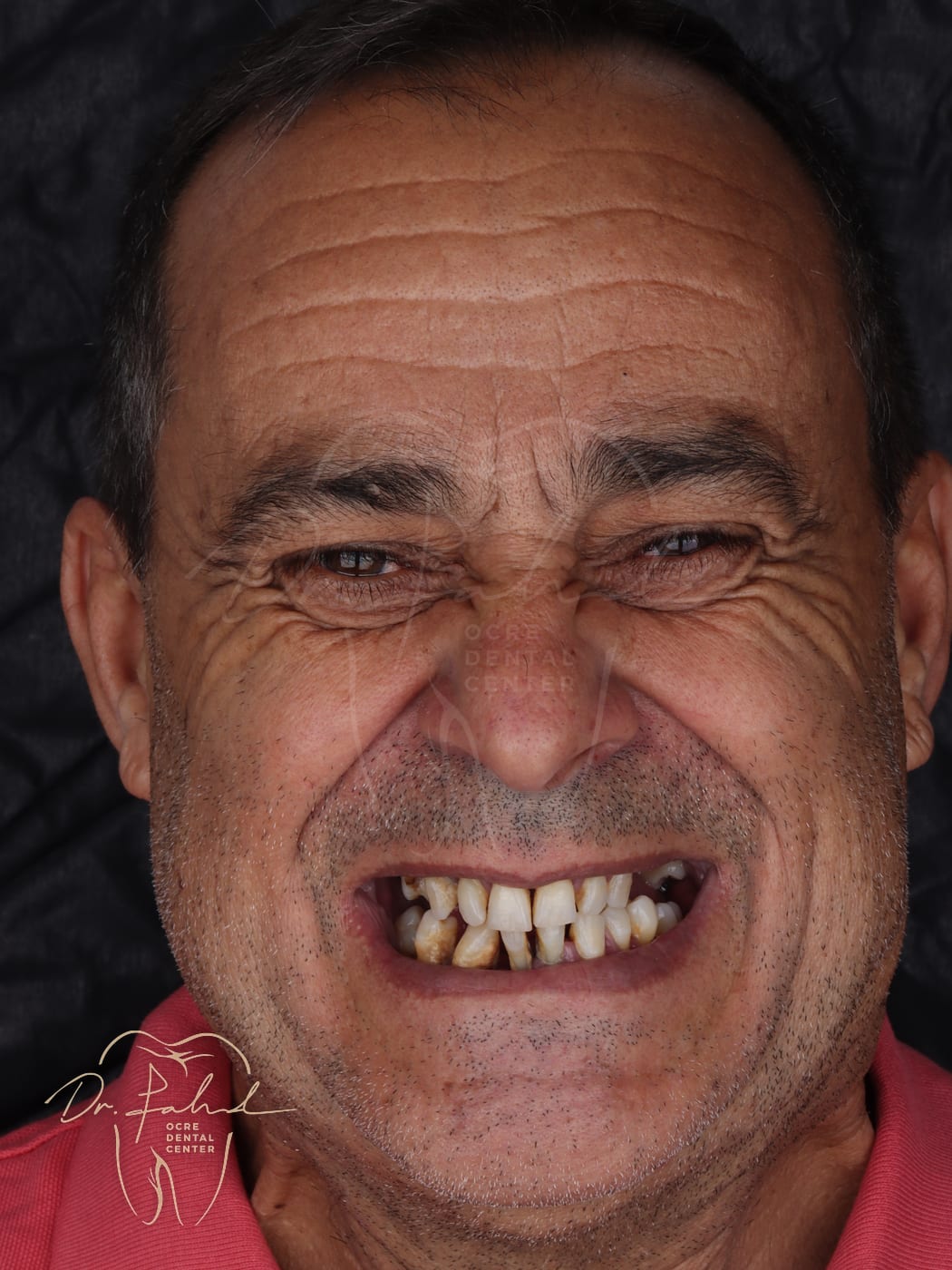 Avant — Cas réel — Implant dentaire, Dr. Fahd, dentiste à Marrakech