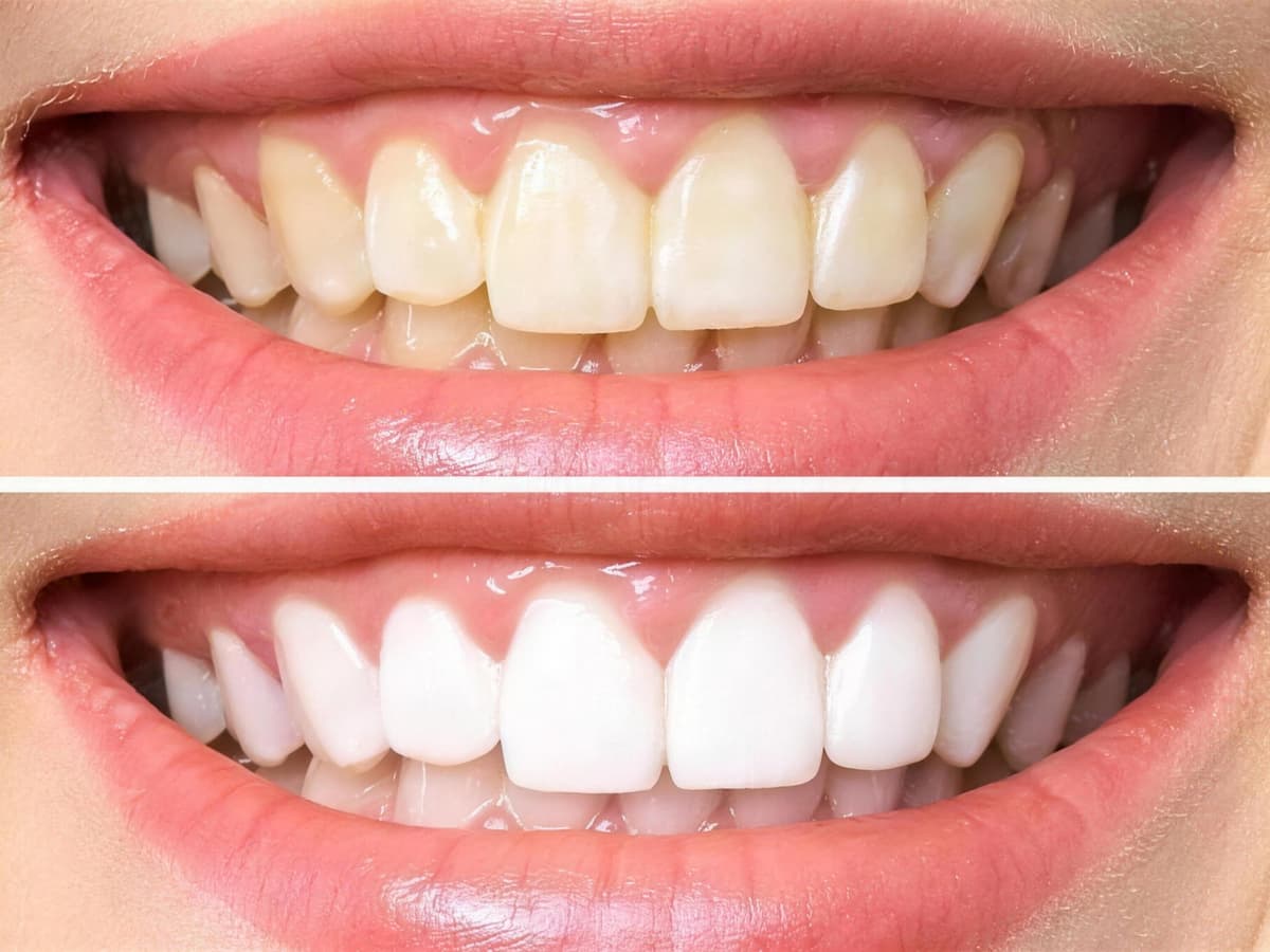 Teeth Whitening in Marrakech — A natural glow, without harming the enamel · Dentist in Marrakesh, Ocre dental clinic