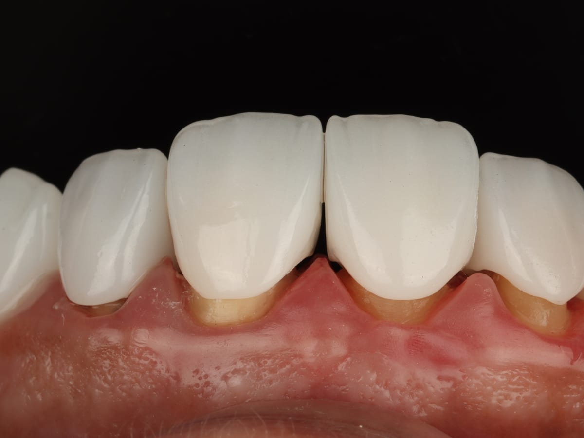 Zirconia Crown in Marrakech — Strength and aesthetics, metal-free · Dentist in Marrakesh, Ocre dental clinic