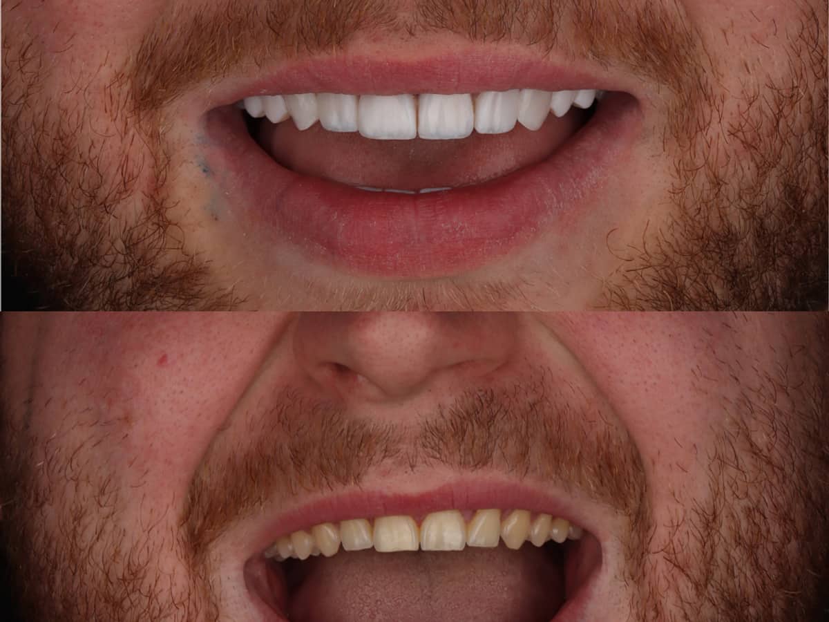Composite Veneers in Marrakech — Hand-sculpted, without filing the tooth · Dentist in Marrakesh, Ocre dental clinic