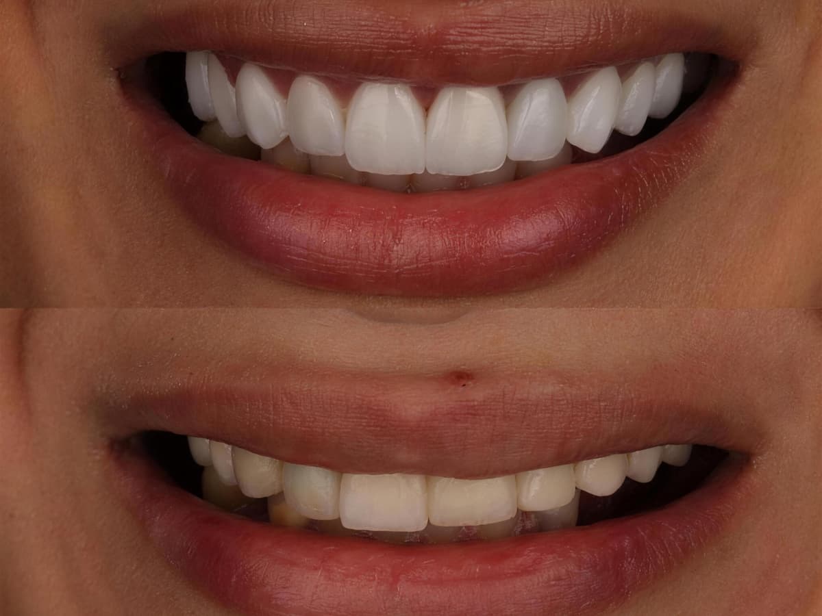 Emax Veneers in Marrakech — The ceramic benchmark for an exceptional smile · Dentist in Marrakesh, Ocre dental clinic