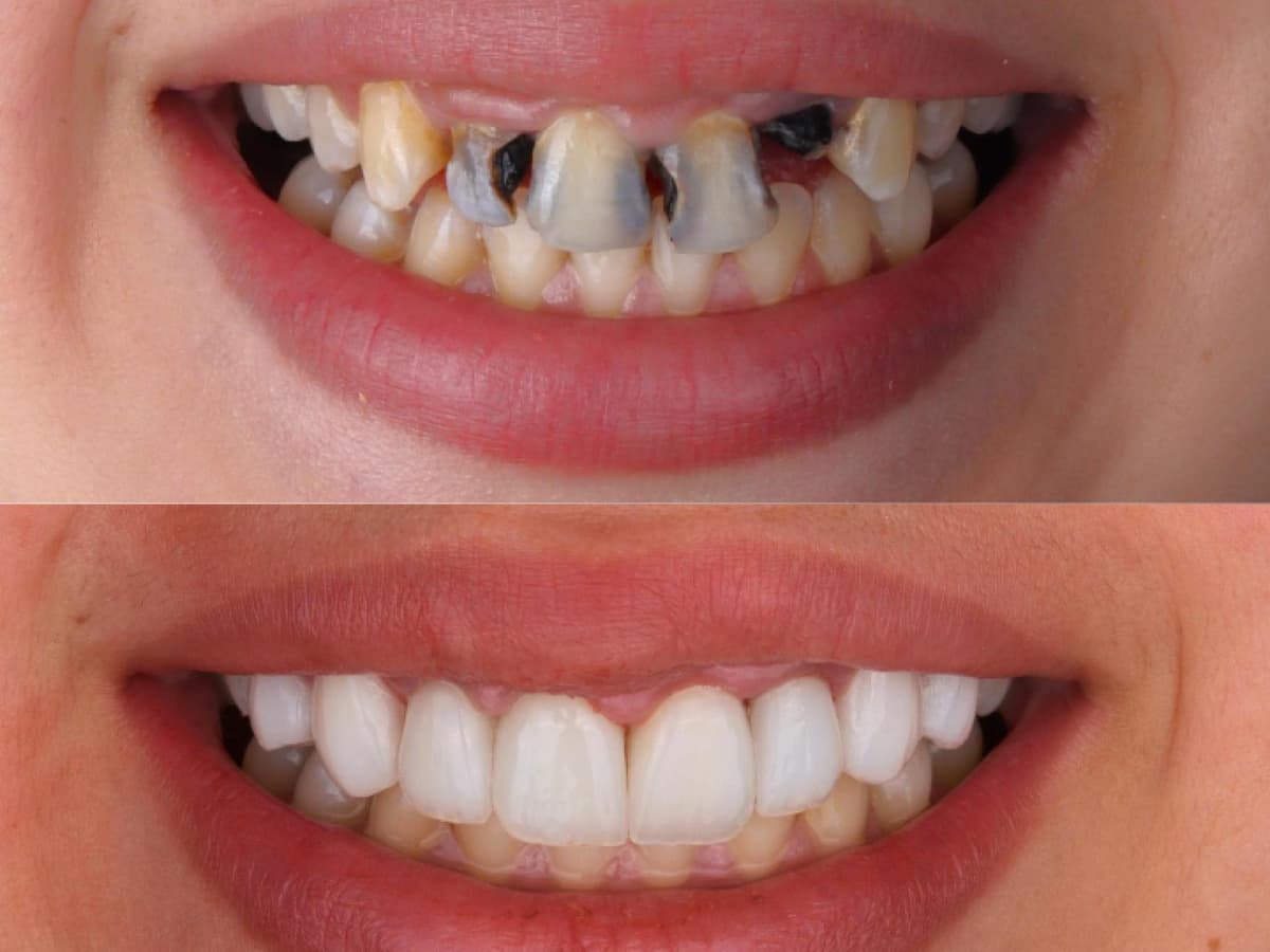 Smile Rehabilitation in Marrakech — Hollywood Smile — a fully redesigned smile · Dentist in Marrakesh, Ocre dental clinic
